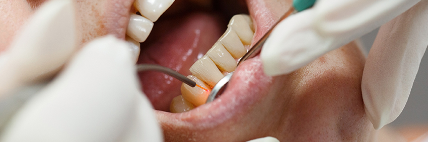 レーザー治療は歯周病改善に効果があるの？