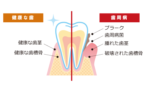 健康な歯と歯周病